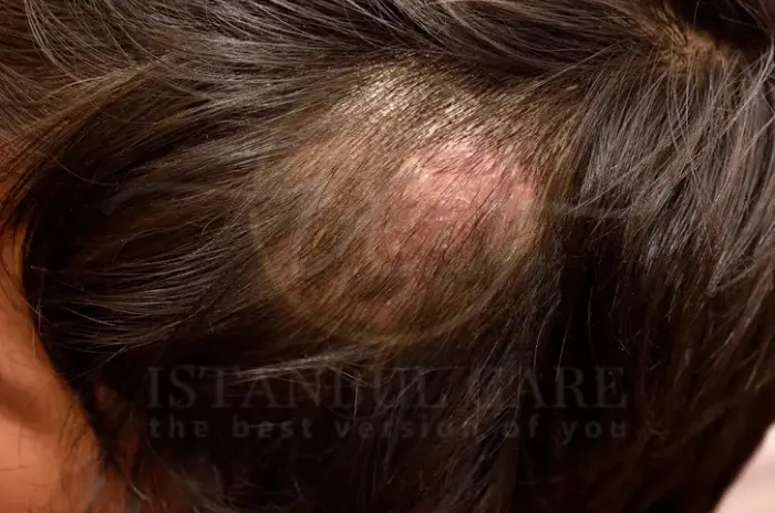 Symptoms and causes of ringworm in the hair
