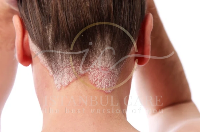 Scalp Acne