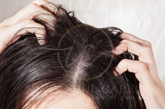 dry scalp