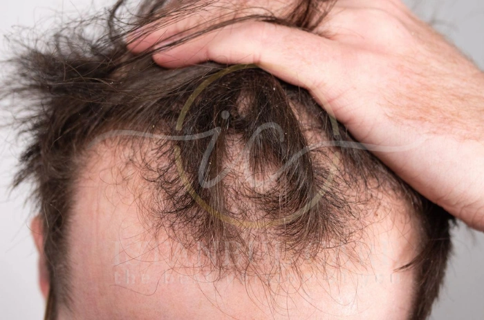 hair thinning causes hair thinning causes