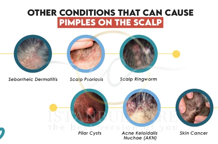 skin products causing acne