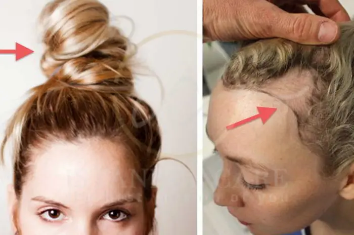 Frontal fibrosing alopecia signs risks and treatment