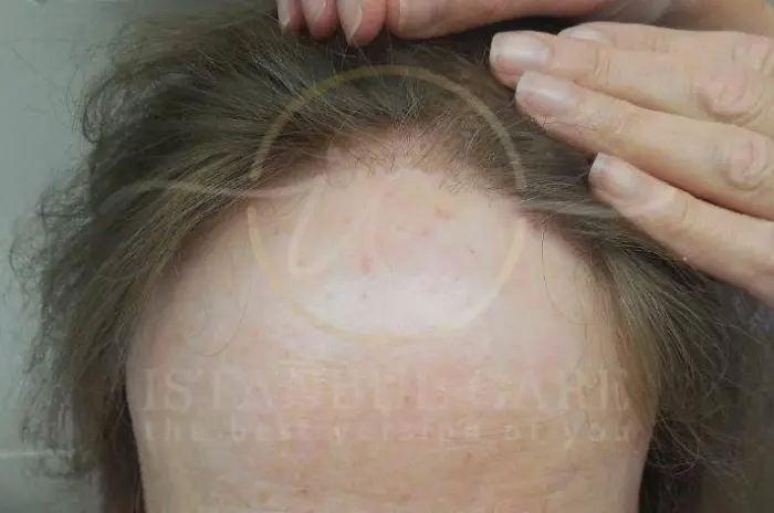 Frontal fibrosing alopecia symptoms and risks