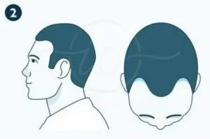 Norwood 2 guide medications transplant options results
