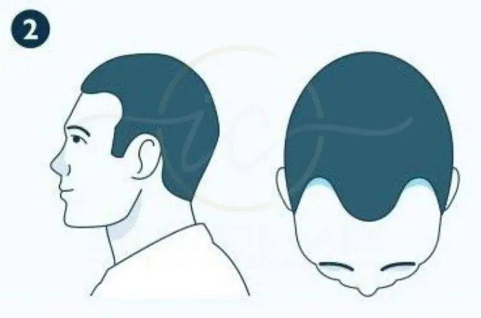 Norwood 2 guide medications transplant options results