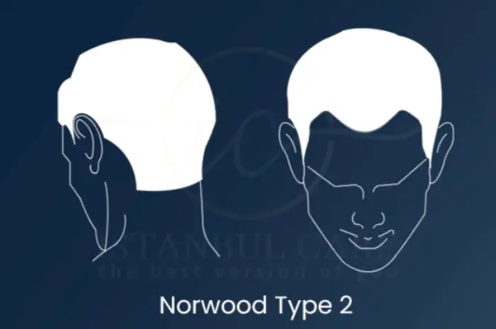 Norwood 2 guide