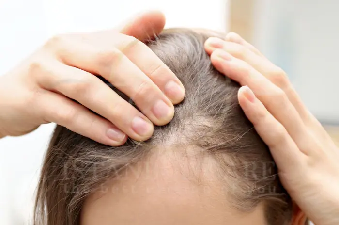 Symptoms of frontal fibrosing alopecia