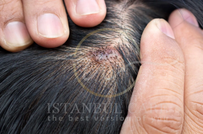 contact dermatitis bump on scalp