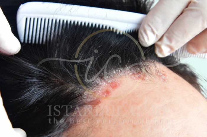 scalp skin cancer scalp skin cancer