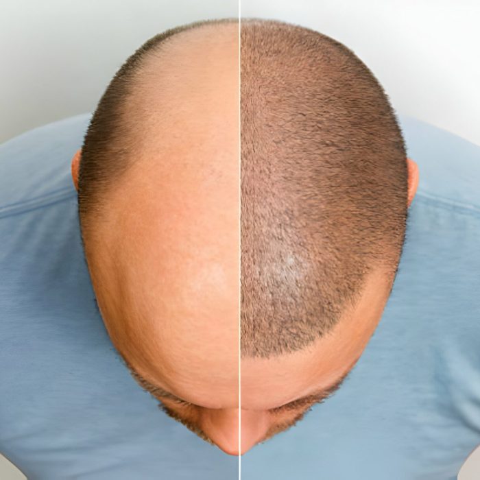 Before and after hair transplant
